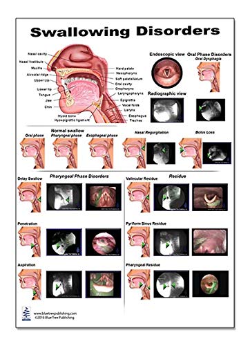 Swallow Disorders Anatomy Poster 12X17Inch, Dysphagia Endoscopic View-Oral Phase Disorders-Nasal Regurgitation