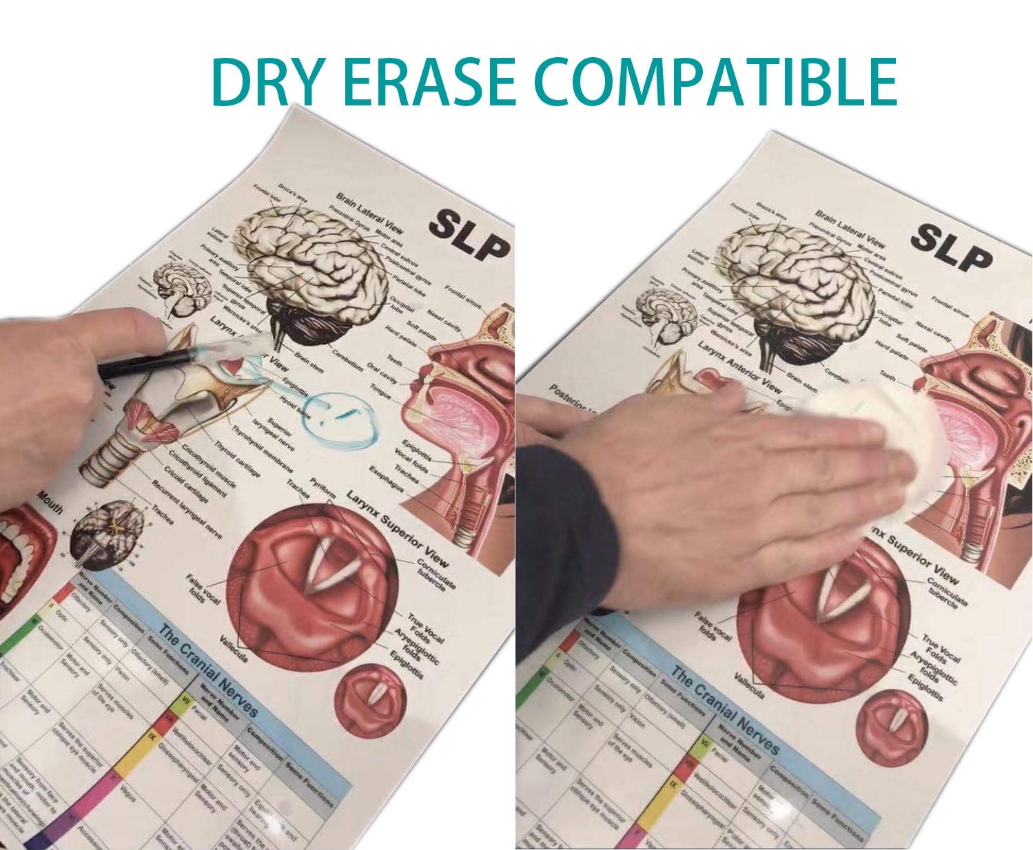 Swallow Disorders Anatomy Poster 12X17Inch, Dysphagia Endoscopic View-Oral Phase Disorders-Nasal Regurgitation